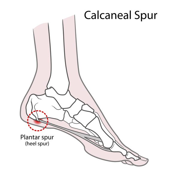 plantar-spur-calcaneal-spur-human-foot-bones-vector-illustration-isolated-on-a-white-background