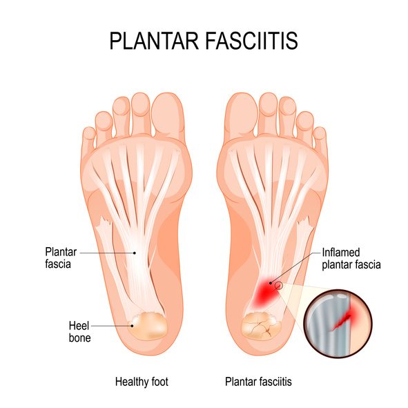 plantar-fasciitis-disorder-of-the-connective-tissue-which-supports-the-arch-of-the-foot