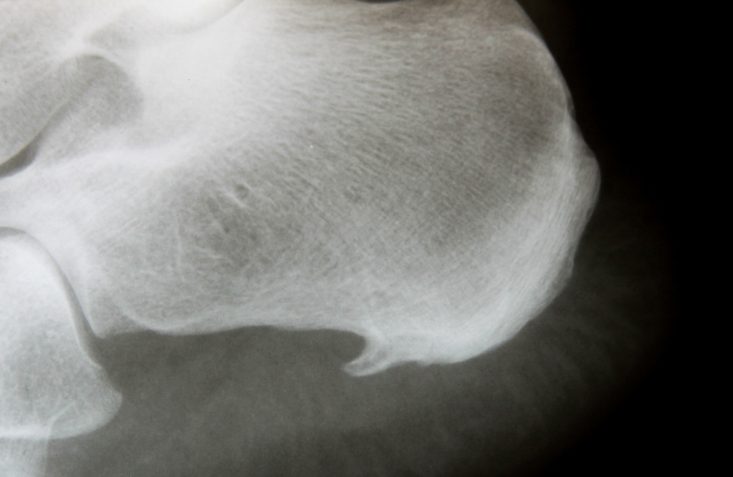 x-ray-image-of-heel-with-calcaneal-spur-athletes-foot-syndrome-insertion-tendopathy